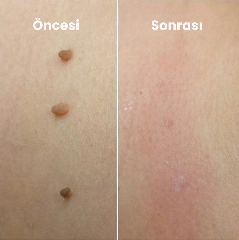 Cildiva et beni giderici kit